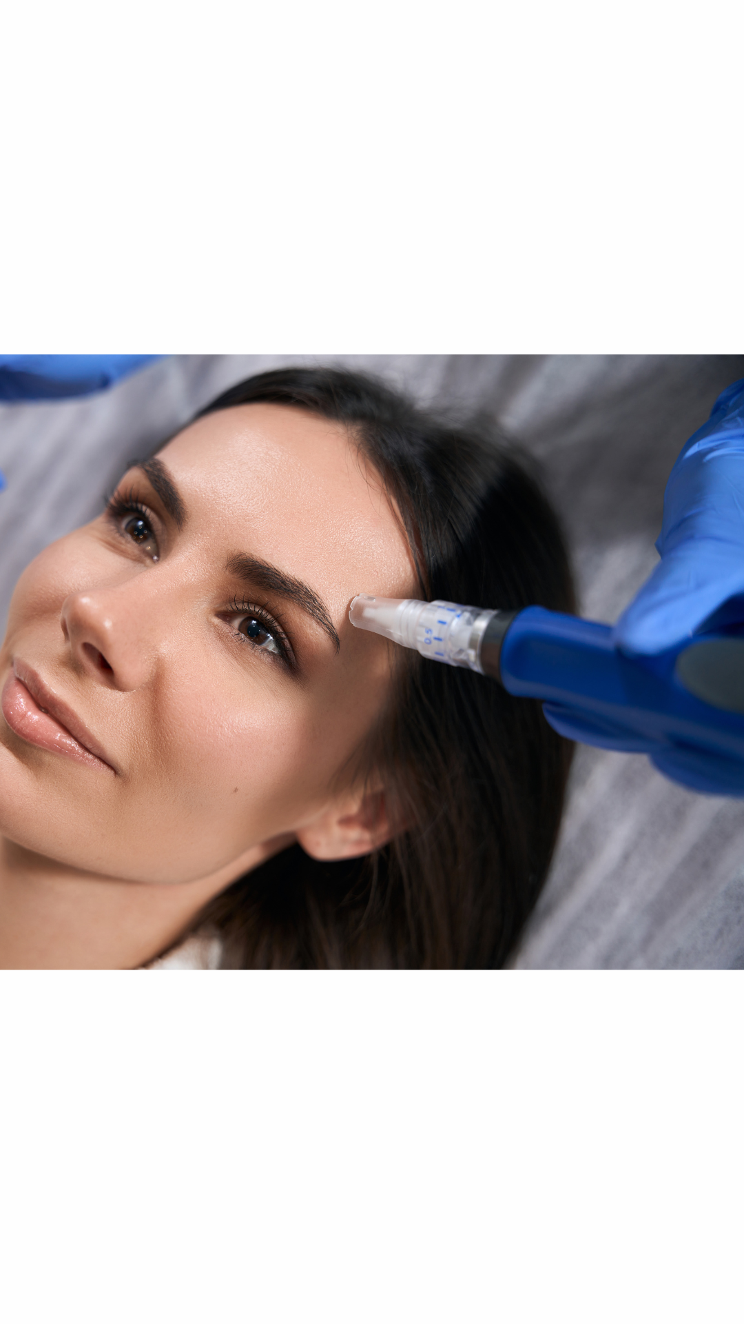 Woman receiving microneedling treatment or collagen induction  on her forehead by a gloved hand.