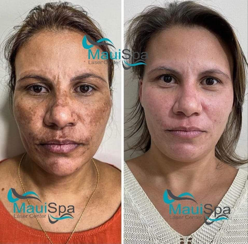 MAUI SPA LASER CENTER