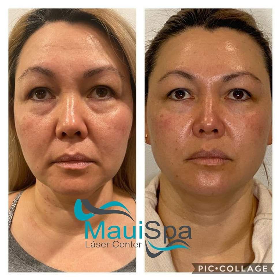 MAUI SPA LASER CENTER