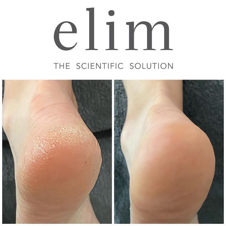Before and after view of a foot's heel. Left side is dry, cracked skin. Right side is smooth.
