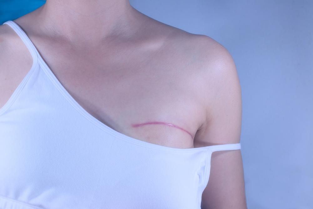 Woman With a Scar on Her Chest is Wearing a White Tank Top — Mullumbimby Comprehensive Health Centre in Mullumbimby, NSW