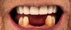 Close-up of teeth with yellowed front teeth and gums visible in a smile