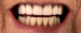 Close-up of yellowed front teeth with a visible gap and reddish gums