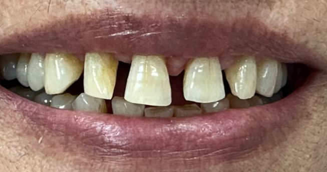 Close-up of a mouth with missing front teeth and yellowed teeth, lips slightly parted