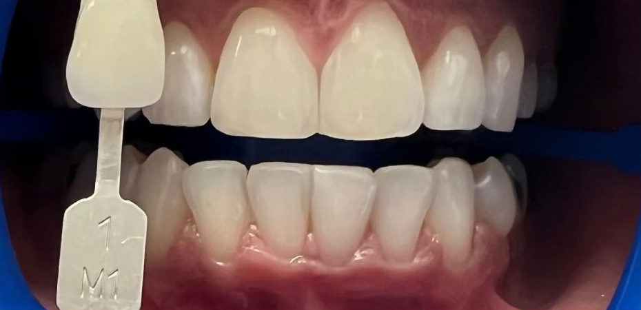Teeth color comparison chart against upper front teeth, showing a brighter shade on the left
