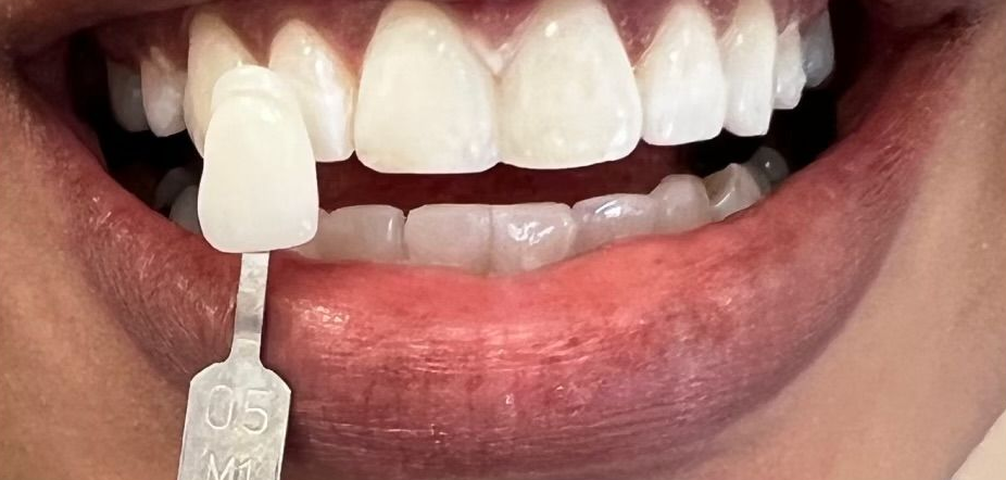 Close-up of teeth while using a white tooth shade guide against the front tooth