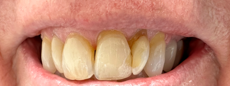 Close-up of a mouth with missing front teeth and yellowed teeth