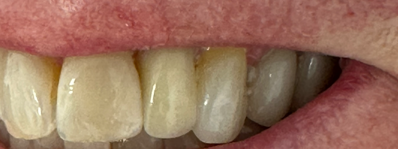 Close-up of a smiling mouth with white upper teeth and discolored lower teeth