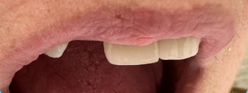 Close-up of a person's mouth with slightly parted lips and visible front teeth