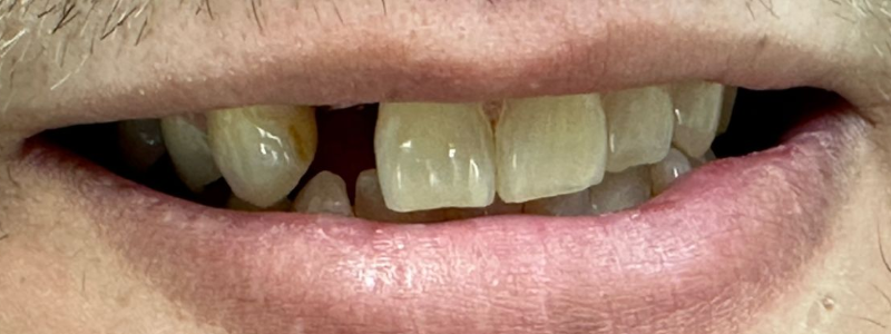 Close-up of severely damaged, missing front teeth with exposed gums and worn, discolored teeth.