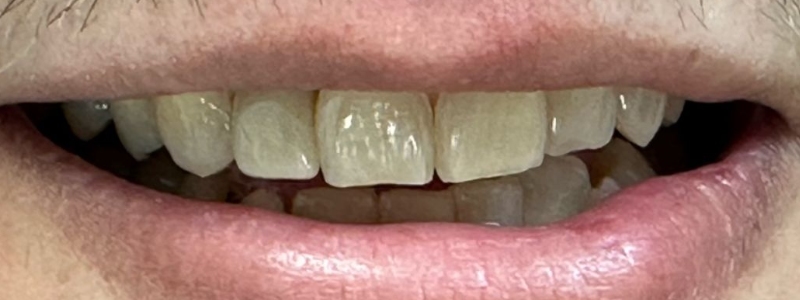 Close-up of open mouth showing upper and lower teeth with off-white discoloration and gums