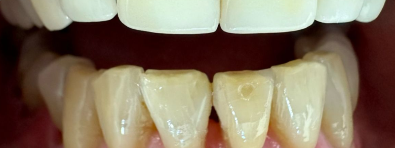 Close-up of yellowed lower teeth beneath white upper teeth, mouth slightly open