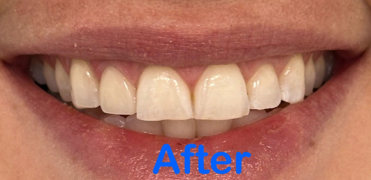 Close-up of a smiling mouth with straight white teeth and the word “After” in blue.