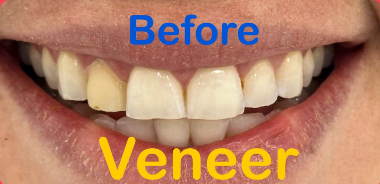 Close-up of teeth with blue “Before” and yellow “Veneer” text, showing a before-and-after dental comparison