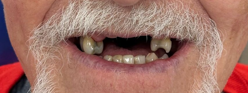 Close-up of a mouth with missing and crooked teeth and a white mustache.