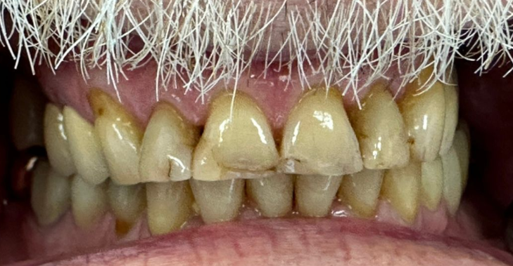 Close-up of yellowed, crowded teeth with white facial hair above the mouth