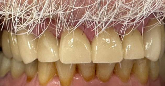 Close-up of stained human teeth, with white upper teeth and yellow-brown lower teeth.