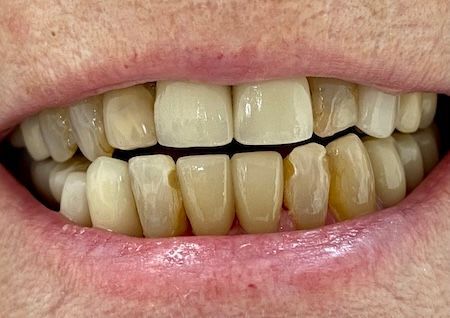 A close up of a person 's teeth with white teeth.