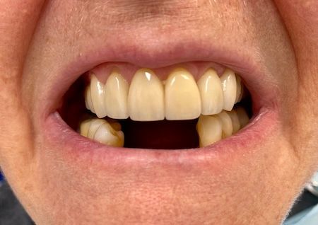 A close up of a man 's mouth with his teeth showing.