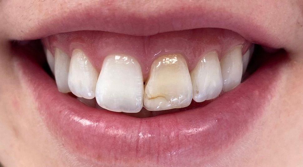 A close up of a person 's teeth with a broken tooth.