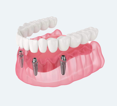 A dental illustration showing a full set of teeth supported by four titanium dental implants in a pink gum model.