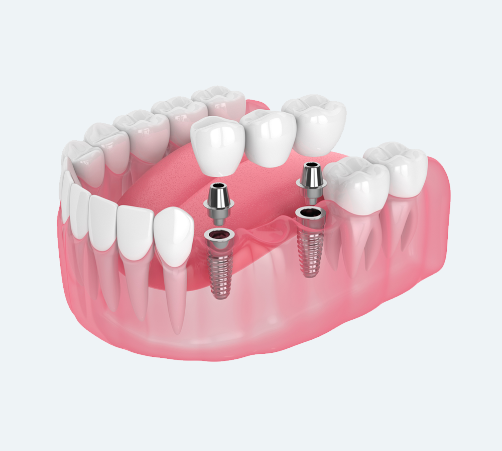 A dental bridge supported by two implants shown above a cross-section of a pink gum line and jawbone.