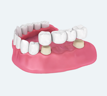 A dental crown being placed over a prepared tooth in a set of human gums and teeth.