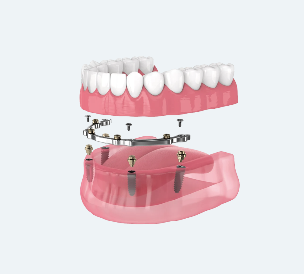 3D diagram showing an implant-supported dental bridge being attached to dental implants in the lower jaw.