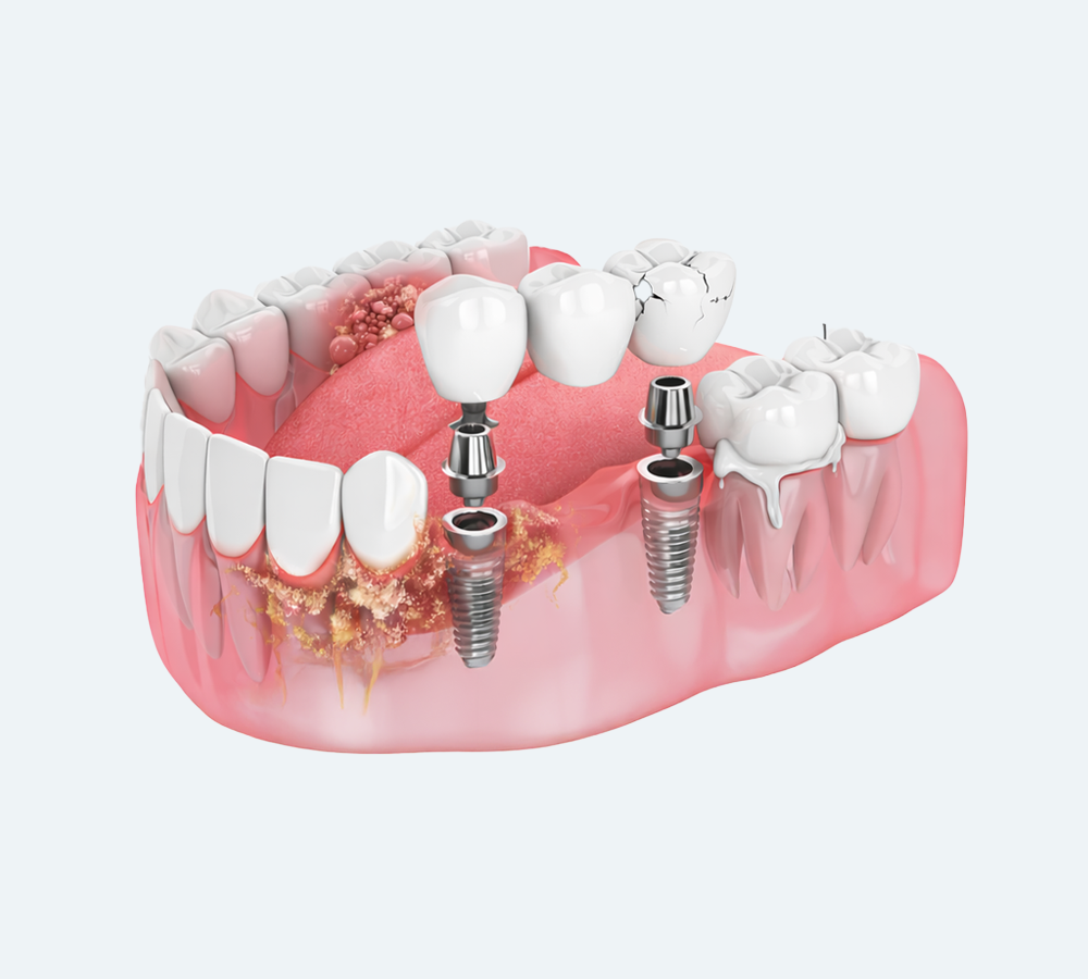 A medical illustration showing a three-unit dental bridge supported by two implants in the lower jaw.