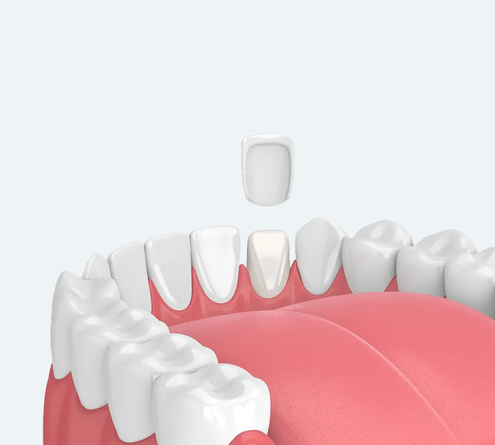 A dental veneer hovering above a prepared tooth in a digital model of a human mouth.