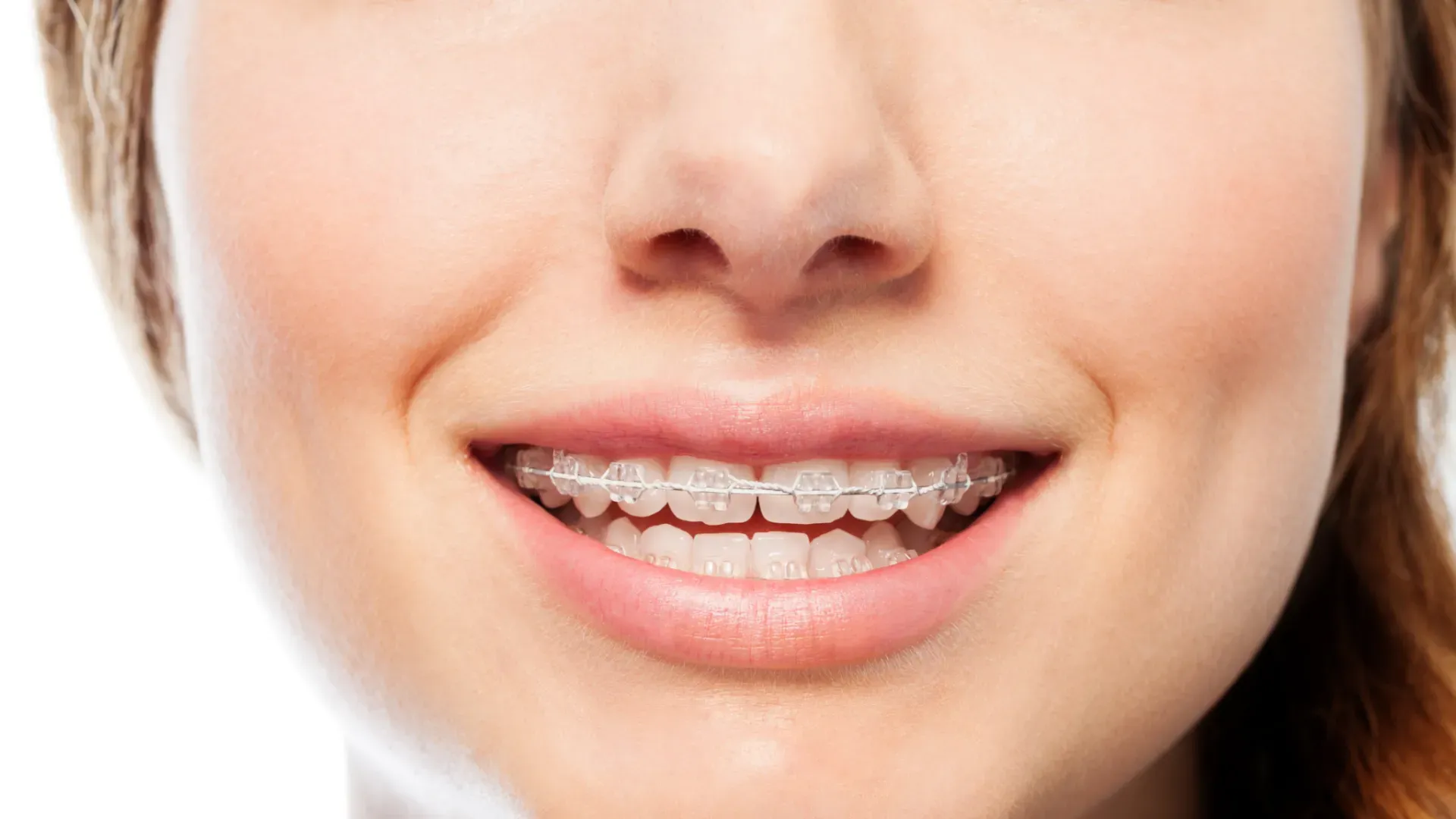 a close-up of a woman's face with braces on her teeth.