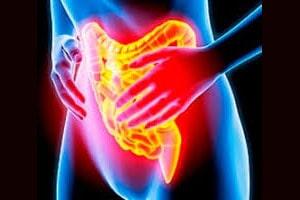 DR. ABELARDO CORREA CHAVEZ - hemorroides