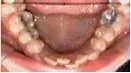 A close up of a person 's mouth with a lot of teeth.