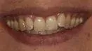 A close up of a person 's mouth with white teeth.