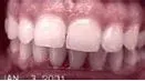 A close up of a person 's teeth with a red background.