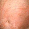 Image of a Body with Hives That Look Like a Rash — Canberra, Act — Healthy Skin Solutions Image of a Body with Hives That Look Like a Rash — Canberra, Act — Healthy Skin Solutions