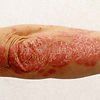 Image of an Arm with a Non-Infectious Skin Condition Psoriasis — Canberra, Act — Healthy Skin Solutions Image of an Arm with a Non-Infectious Skin Condition Psoriasis — Canberra, Act — Healthy Skin Solutions