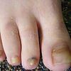 Image of Feet That Have a Bacterial Infection — Canberra, Act — Healthy Skin Solutions Image of Feet That Have a Bacterial Infection — Canberra, Act — Healthy Skin Solutions