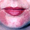 Image of a Face with Many Red Spots — Canberra, Act — Healthy Skin Solutions Image of a Face with Many Red Spots — Canberra, Act — Healthy Skin Solutions