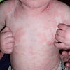 Image of a Body of a Child Have an Eczema — Canberra, Act — Healthy Skin Solutions Image of a Body of a Child Have an Eczema — Canberra, Act — Healthy Skin Solutions