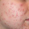 Image of a Face with a Very Common Skin Condition They Called Acne — Canberra, Act — Healthy Skin Solutions Image of a Face with a Very Common Skin Condition They Called Acne — Canberra, Act — Healthy Skin Solutions