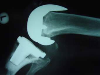 AARON OLIVEROS GONZALEZ - Artroscopia de rodilla