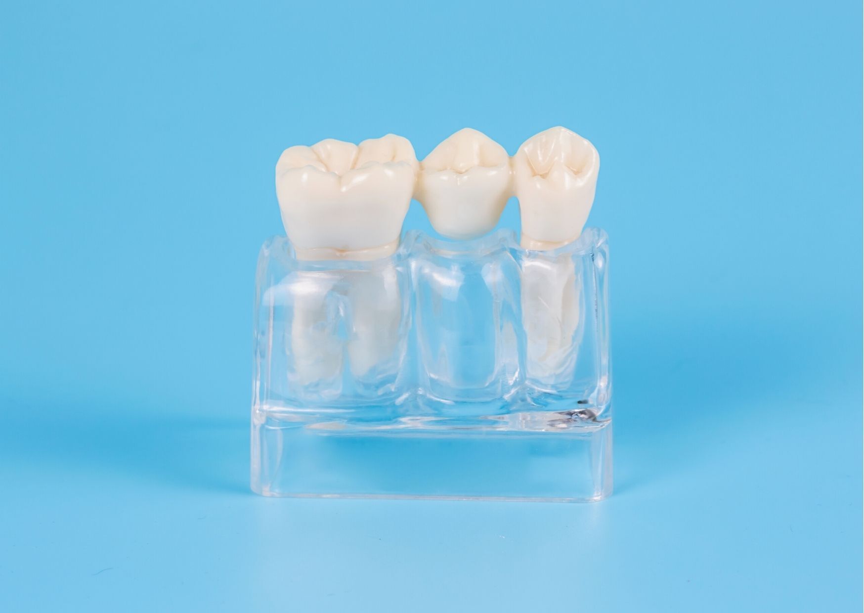Traditional Dental Bridge