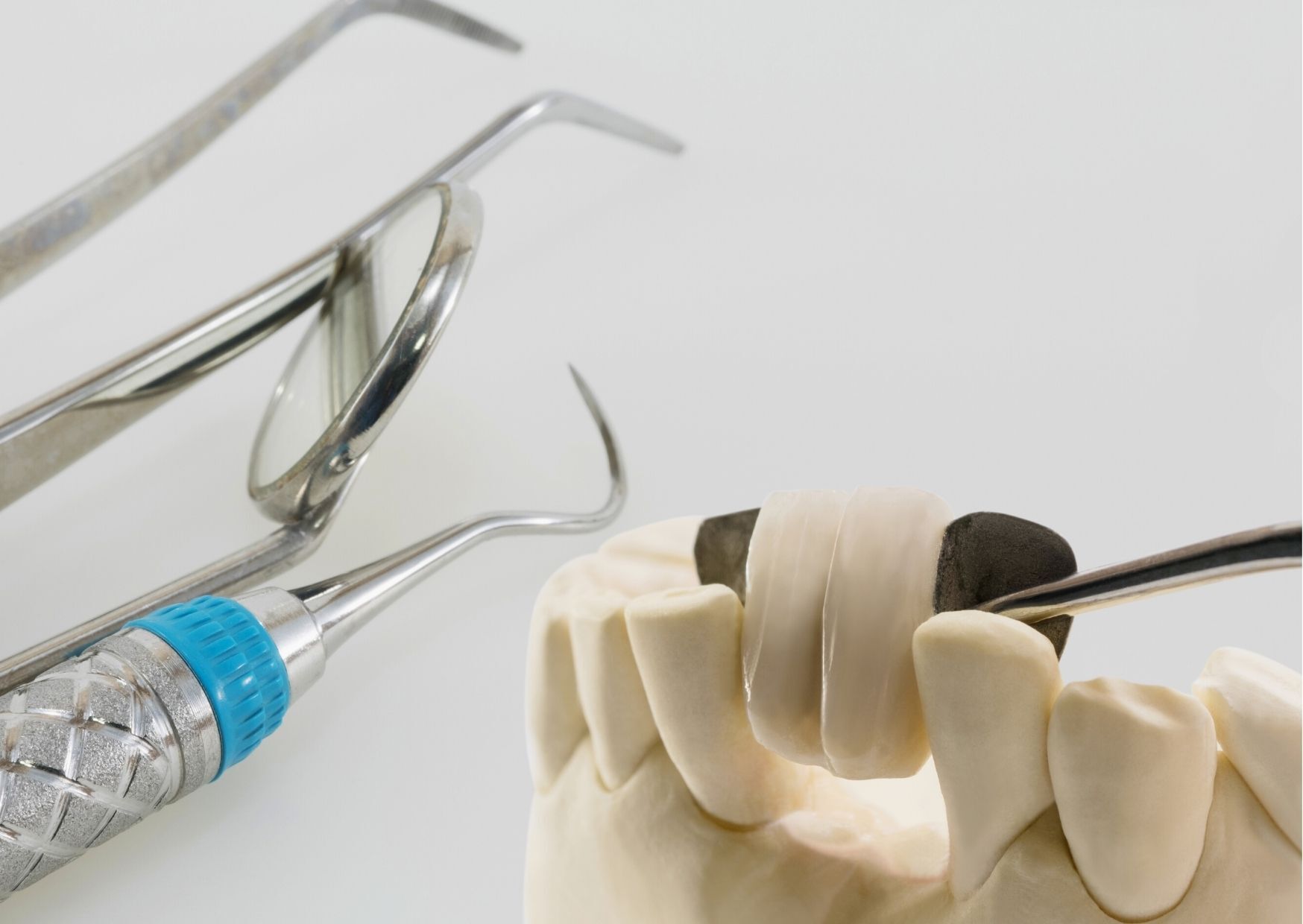 Maryland dental bridge