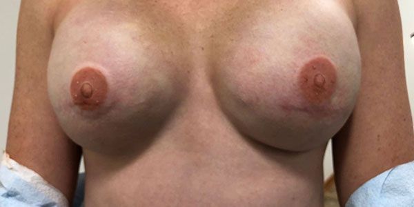 Nipple tattooing after