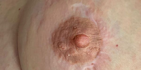 Nipple tattooing after 2