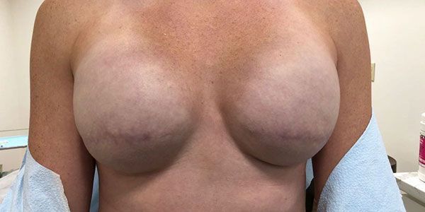  nipple tattooing before