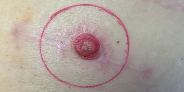 Nipple tattooing before 3