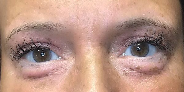 A close up of a woman 's eyes with a swollen eye.