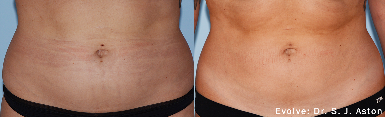 A before and after picture of a woman 's stomach.